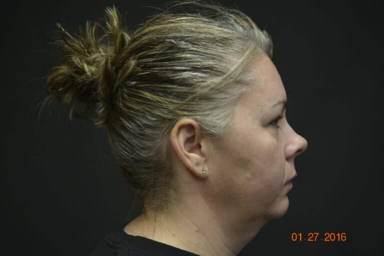 Before Image: Naturale face neck lift - 