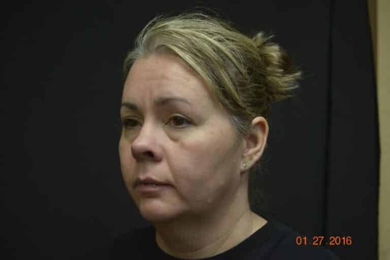 Before Image: Naturale face neck lift - 
