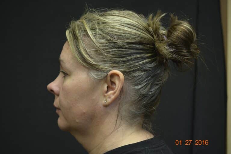 Before Image: Naturale face neck lift - 
