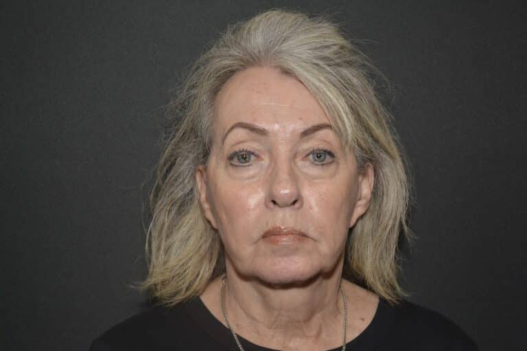 Before Image: Naturale face-neck lift - 