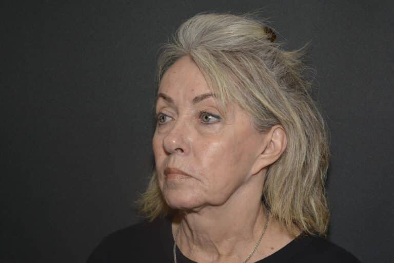 Before Image: Naturale face-neck lift - 