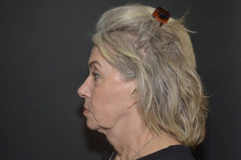 Before Image: Naturale face-neck lift - 
