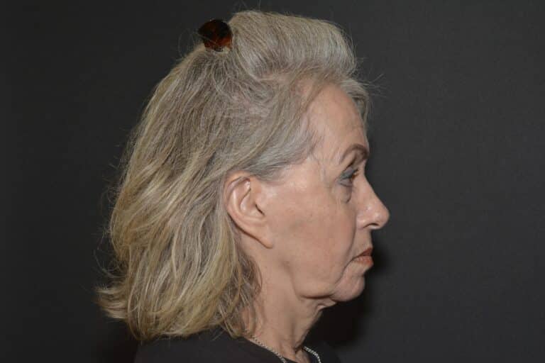 Before Image: Naturale face-neck lift - 