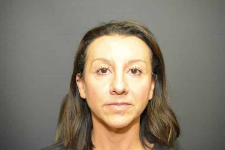 Before Image: Neck Lift - 