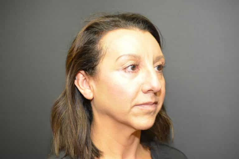 Before Image: Neck Lift - 