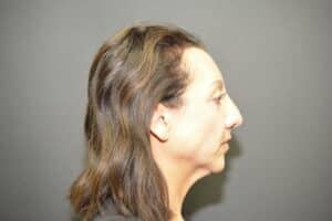 Before Image: Neck Lift