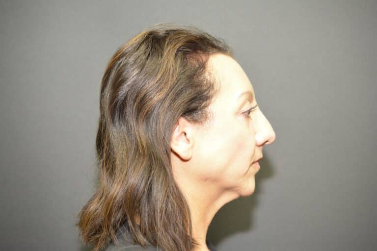 Before Image: Neck Lift - front
