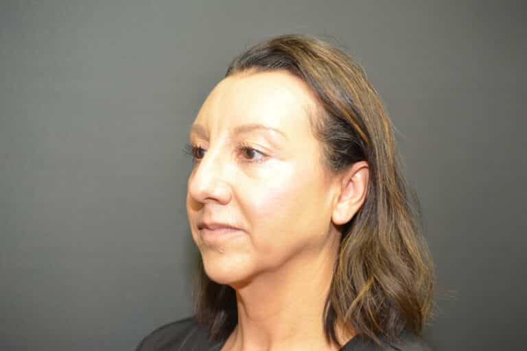 Before Image: Neck Lift - 