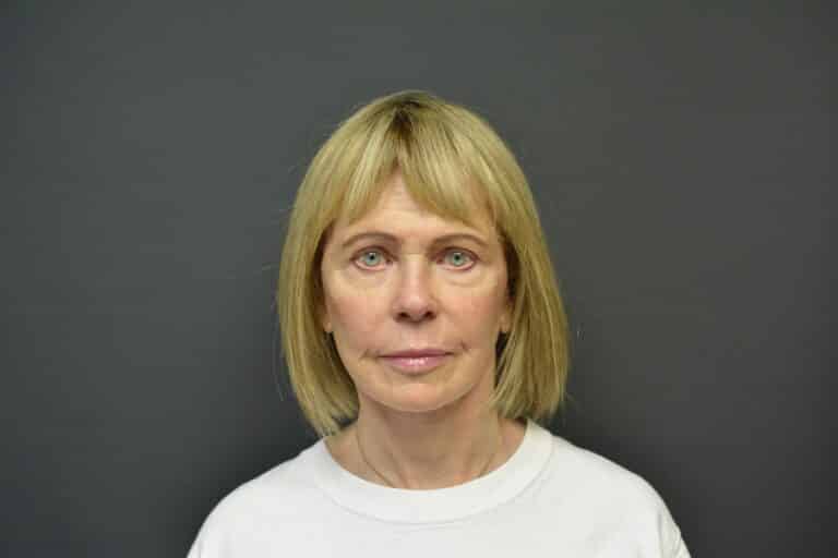 After Image: Naturale face-neck lift - 