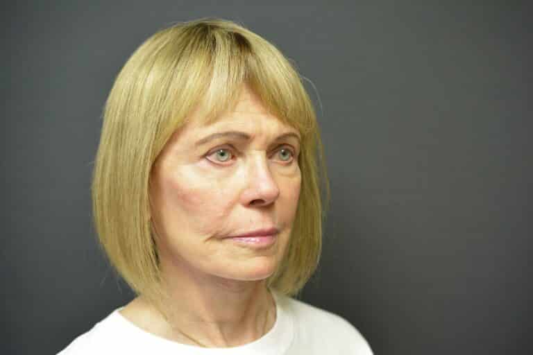 After Image: Naturale face-neck lift - 