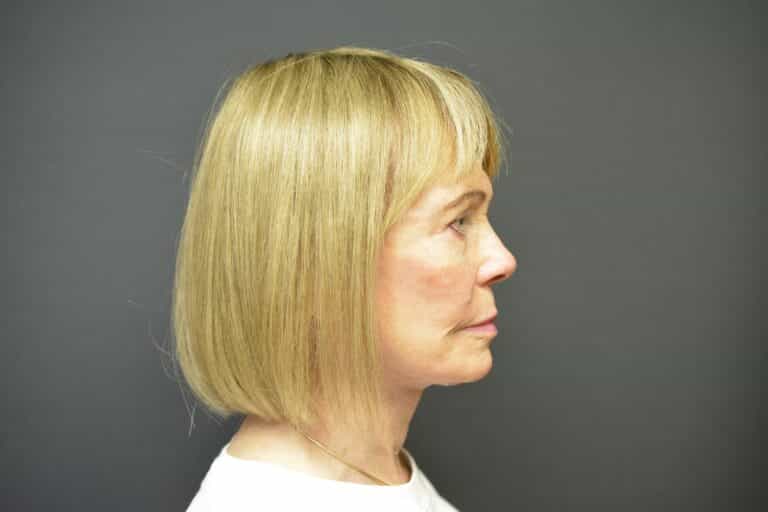 After Image: Naturale face-neck lift - 