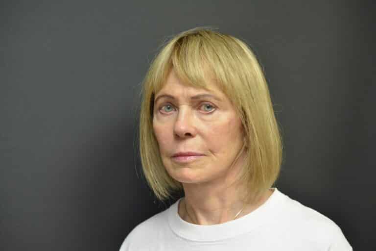 After Image: Naturale face-neck lift - front