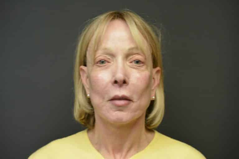 After Image: Naturale face-neck lift with lip lift - 