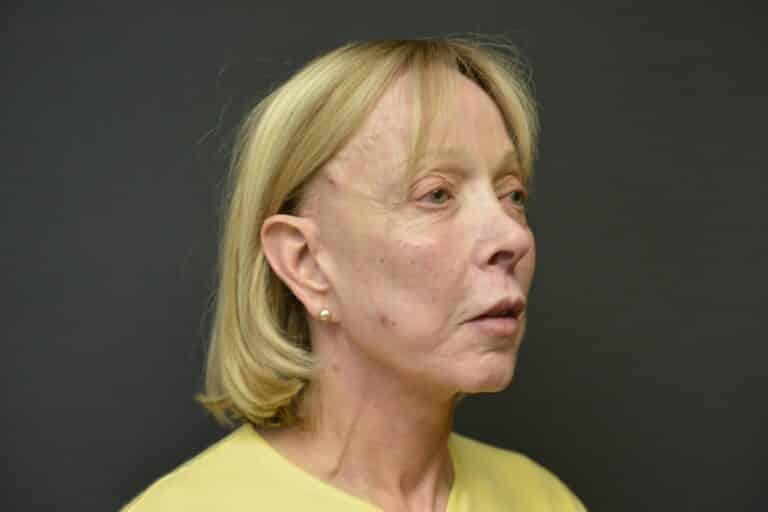 After Image: Naturale face-neck lift with lip lift - 
