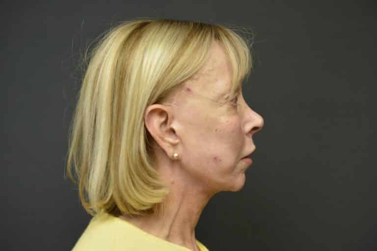 After Image: Naturale face-neck lift with lip lift - 
