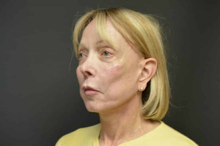 After Image: Naturale face-neck lift with lip lift - front