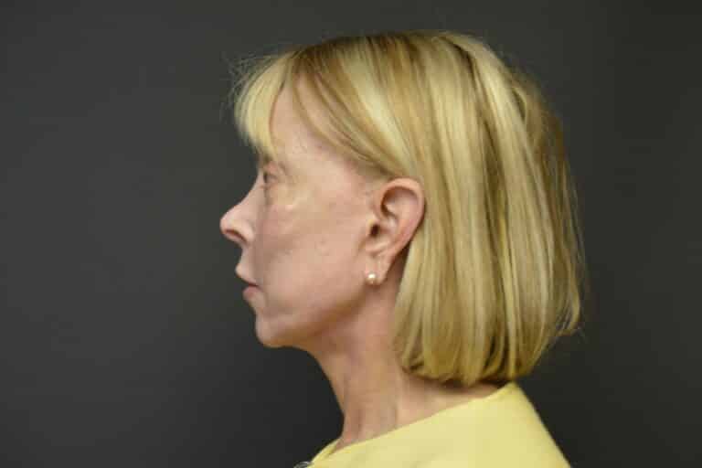 After Image: Naturale face-neck lift with lip lift - 