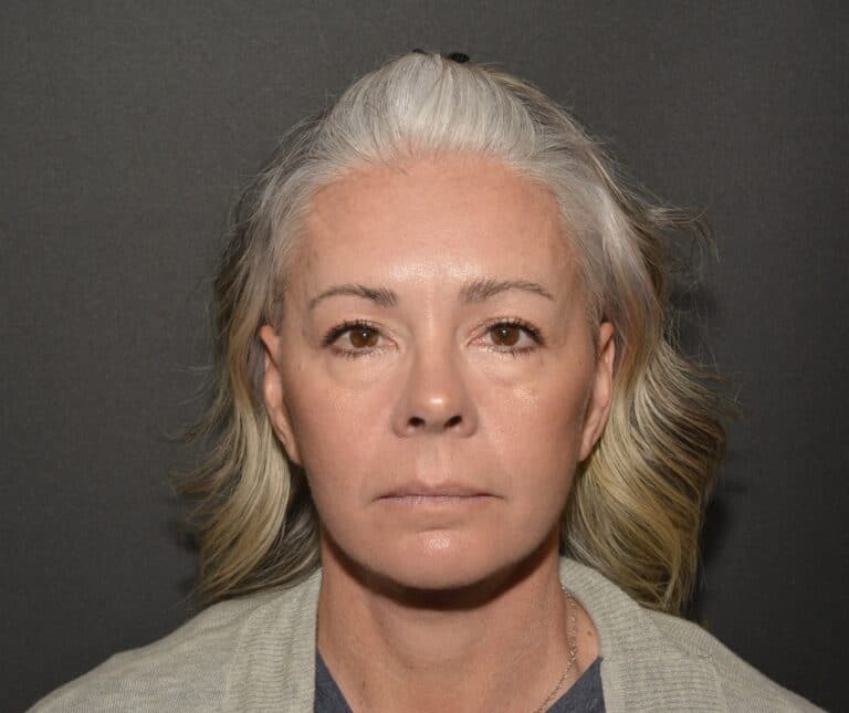 After Image: Naturale face neck lift - 