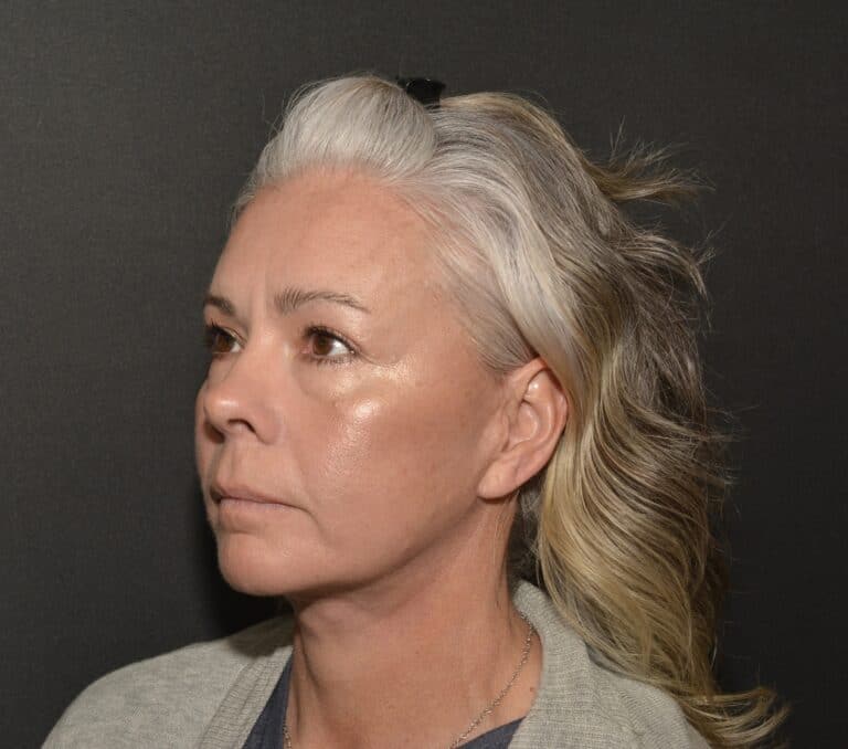 After Image: Naturale face neck lift - 