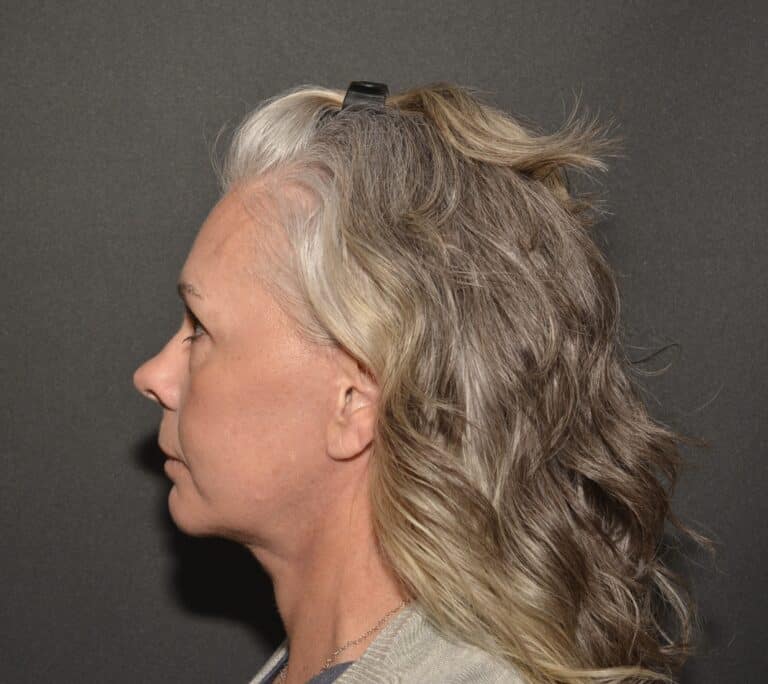 After Image: Naturale face neck lift - 