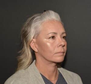 After Image: Naturale face neck lift