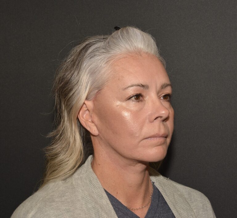 After Image: Naturale face neck lift - front