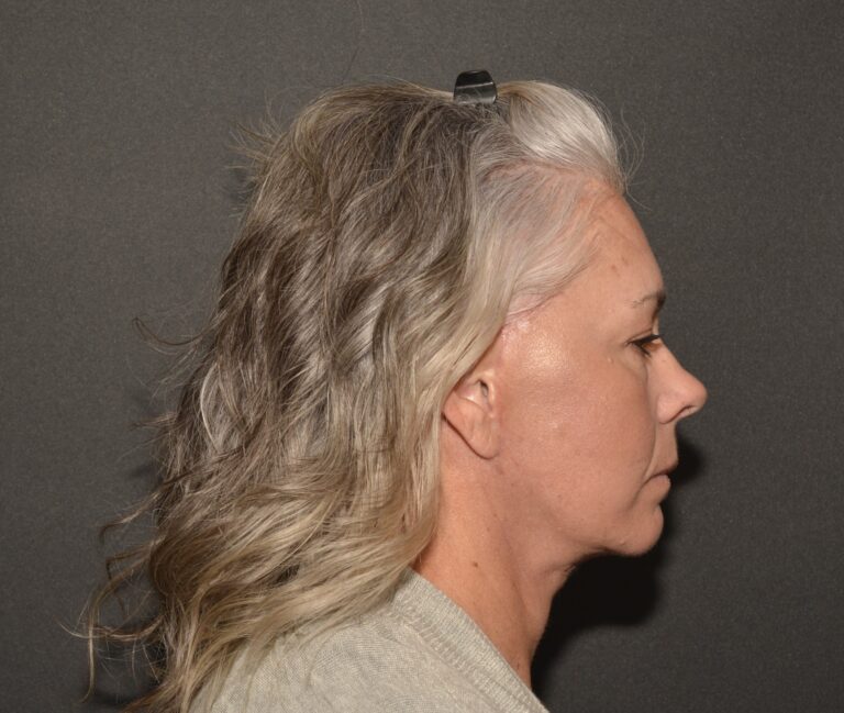 After Image: Naturale face neck lift - 