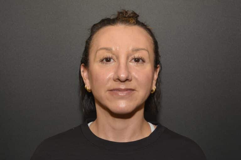After Image: Neck Lift - 