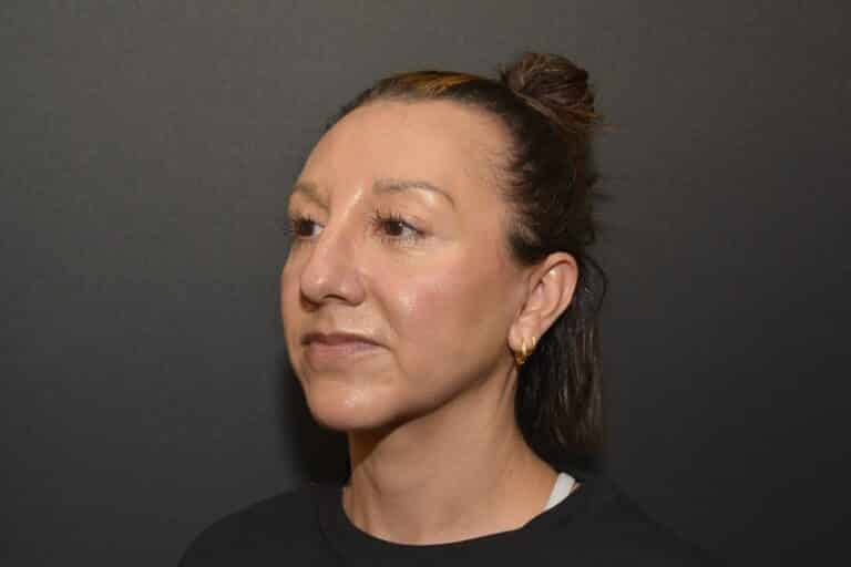 After Image: Neck Lift - 