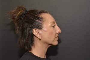 After Image: Neck Lift