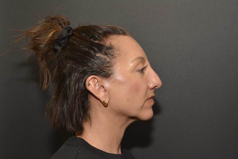 After Image: Neck Lift - front