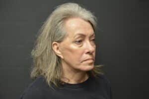 After Image: Naturale face-neck lift