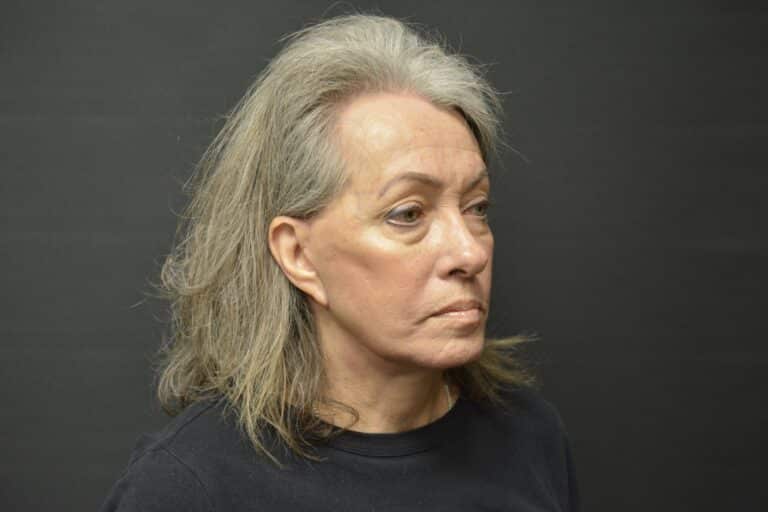 After Image: Naturale face-neck lift - front