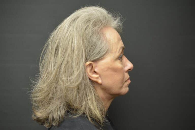 After Image: Naturale face-neck lift - 