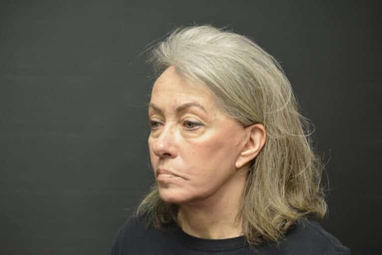 After Image: Naturale face-neck lift - 