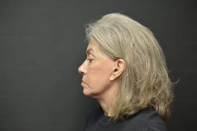 After Image: Naturale face-neck lift - 