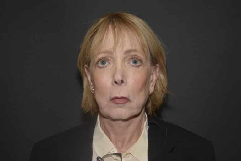 Before Image: Naturale face-neck lift with lip lift - 