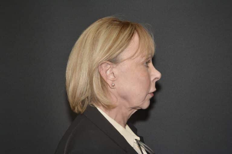Before Image: Naturale face-neck lift with lip lift - 