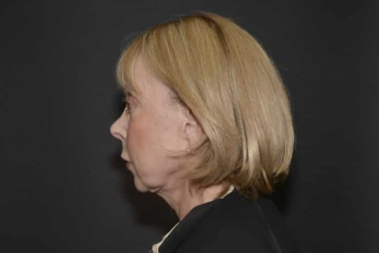 Before Image: Naturale face-neck lift with lip lift - 