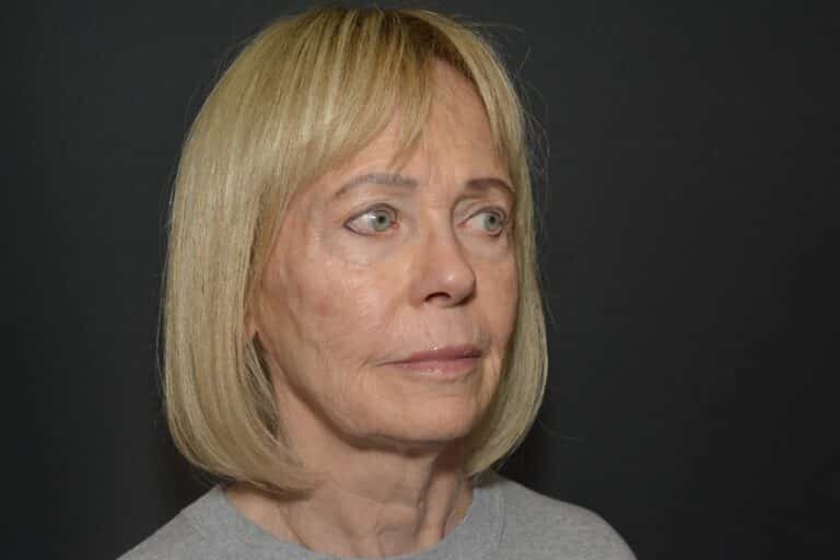 Before Image: Naturale face-neck lift - 
