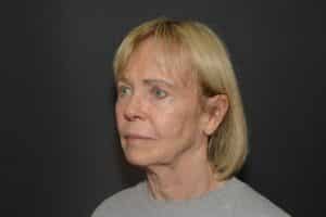 Before Image: Naturale face-neck lift