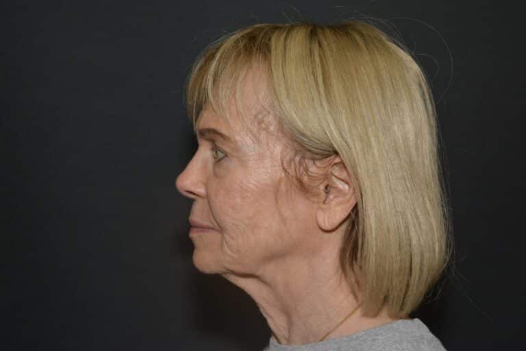 Before Image: Naturale face-neck lift - 