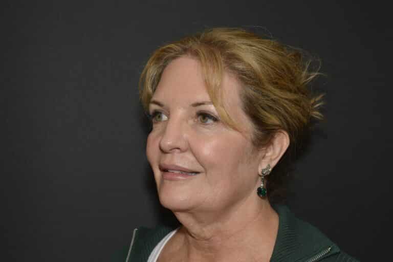 Before Image: Naturale Face-Neck lift - 