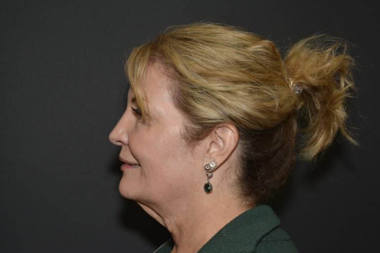 Before Image: Naturale Face-Neck lift - 