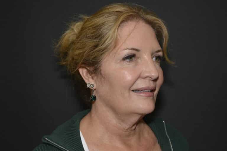 Before Image: Naturale Face-Neck lift - 