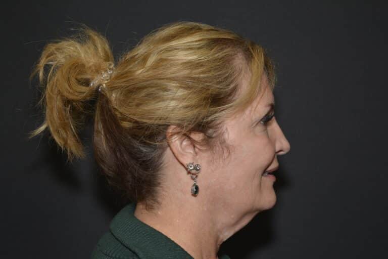 Before Image: Naturale Face-Neck lift - 