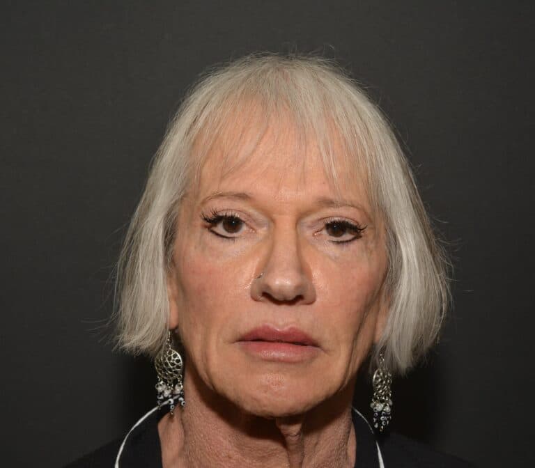 Before Image: Naturale Face neck lift - 