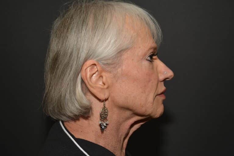 Before Image: Naturale Face neck lift - 