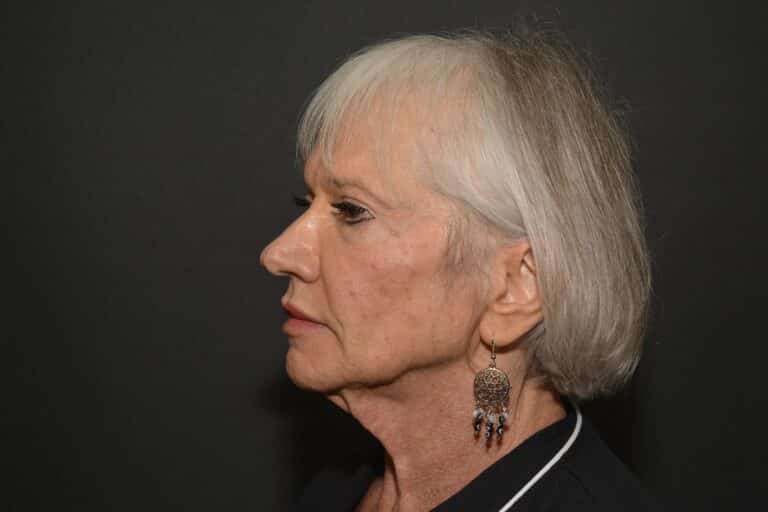 Before Image: Naturale Face neck lift - 