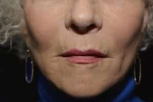 After Image: Lip Lift